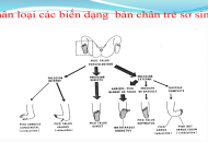 CÁC BIẾN DẠNG BÀN CHÂN Ở TRẺ EM
