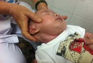 VẸO CỔ BẨM SINH DO TẬT CƠ